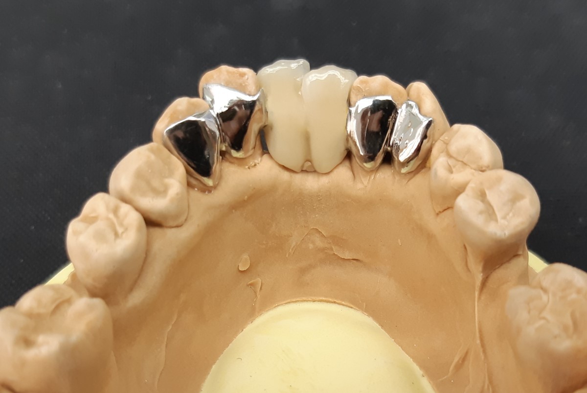 METALODONT 🇫🇷 Laboratoire de Prothèse Dentaire • Bridges collés